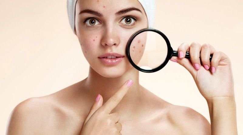 สิวฮอร์โมน สิวรอบเดือน Menstrual Acne, Peroid Acne ดูแลได้อย่างไรบ้าง? สิวฮอร์โมน สิวรอบเดือน Menstrual Acne, Peroid Acne ดูแลได้อย่างไรบ้าง?